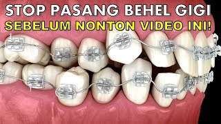 Jangan Sembarang Pasang Behelini Ciri Ciri Gigi Yang Perlu Pakai Behel Gigi