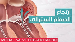 Mitral Valve Regurgitation 💖 ارتجاع الصمام الميترالي