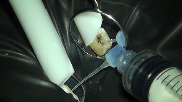 Step by step shaping of calcified MB2 on maxillary molar with 5 canals.