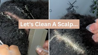 Flaky Scalp Removal On Natural Hair | Satisfying Dandruff Removal