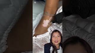como tapara el vitiligo #ideas #hack #viral #vitíligo