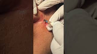 Hemangioma post aural area excision with laser / Cautery - Dr Hitesh Patel