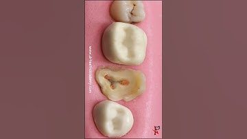 Last Hope of Saving this Tooth! #dentalcavity #dentist