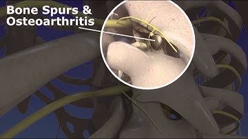 Thoracic Facet Radiofrequency Neurotomy - Upper Back