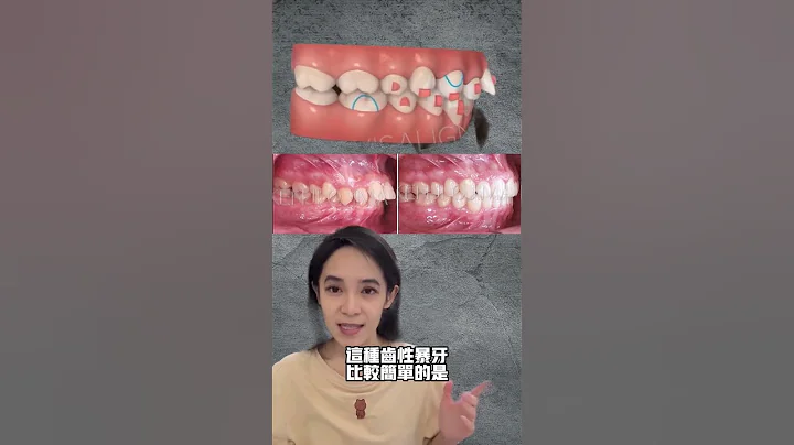 齒性暴牙vs骨性暴牙#暴牙矯正＃戴牙套 - 天天要聞