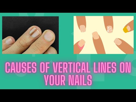 What Do You Do if Your Client Has Beau's Lines? | Nailpro
