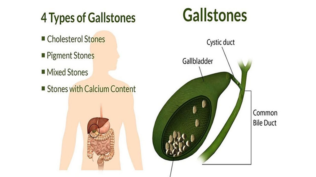 can sulfasalazine cause kidney stones