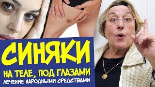 СИНЯКИ на теле без причины || лечение народными средствами СИНЯКИ на теле без причины || лечение народными средствами