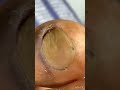 Acute Paronychia