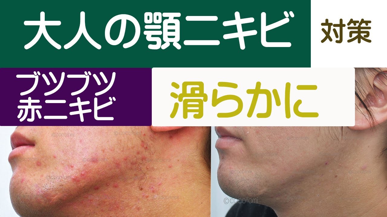 フェイスラインのニキビ対策は根本から 30年以上のニキビ対策専門cocotomi Youtube フェイスラインのニキビ対策は根本から 30年以上のニキビ対策専門cocotomi Youtube