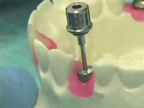 Placing Implant Abutments