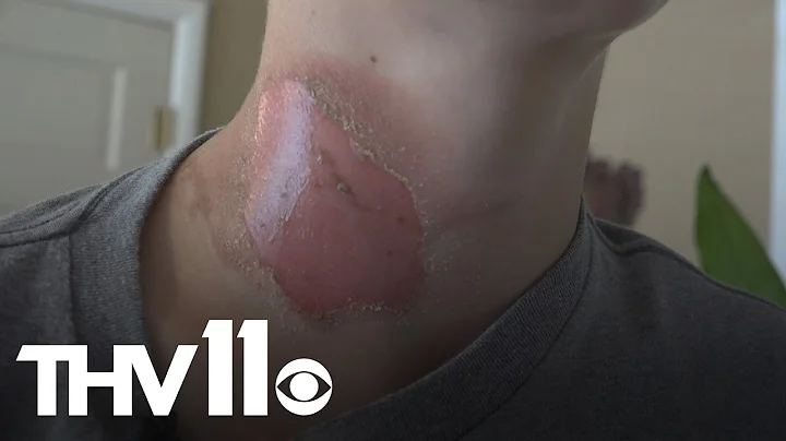 Sleeping teen suffers severe burns after friends throw boiling water on him