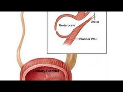 Video: Ureetra Prolapss Ja Uretrocele: Sümptomid, Põhjused Ja Ravi