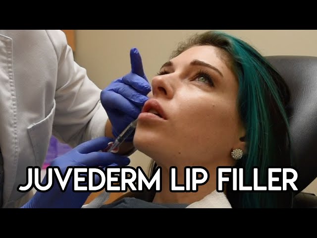 Juvederm Lip Filler