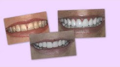 Temporary Veneers as a "Trial Smile" - 5 Star Dental Group - San Antonio 