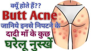 How To Remove Butt (hips) Acne At Home | घर पर butt acne कैसे ठीक करें | दादी मां के घरेलु नुस्खे