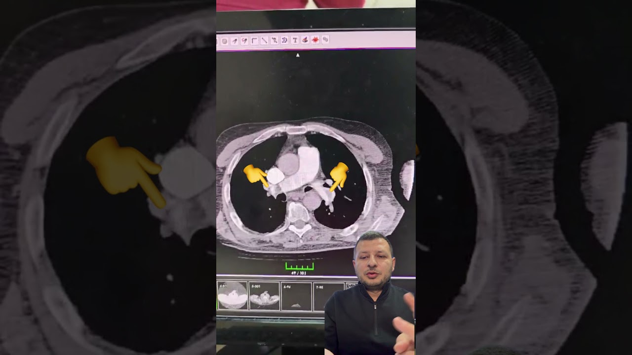 PULMONER EMBOLİ ANJİO TOMOGRAFİ GÖRÜNTÜSÜ