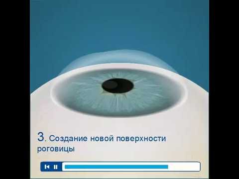 Lasik Custom Vue — индивидуализированная лазерная коррекция