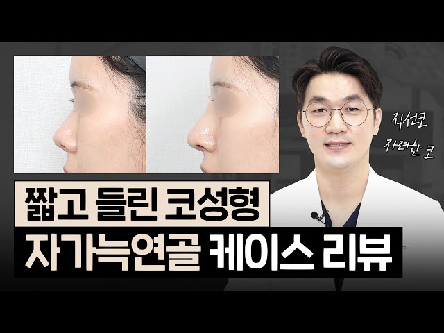짧은코 케이스 리뷰｜자가늑연골 코수술 2주 후 모습은?👃｜콧대부터 코끝, 비주까지 자려한 여자 직선코 사례!