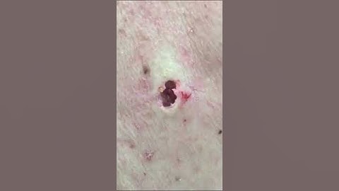 Dr Lee Extracts Biggest Blackhead Yet! #DrPimplePopperThisIsZit #Shorts