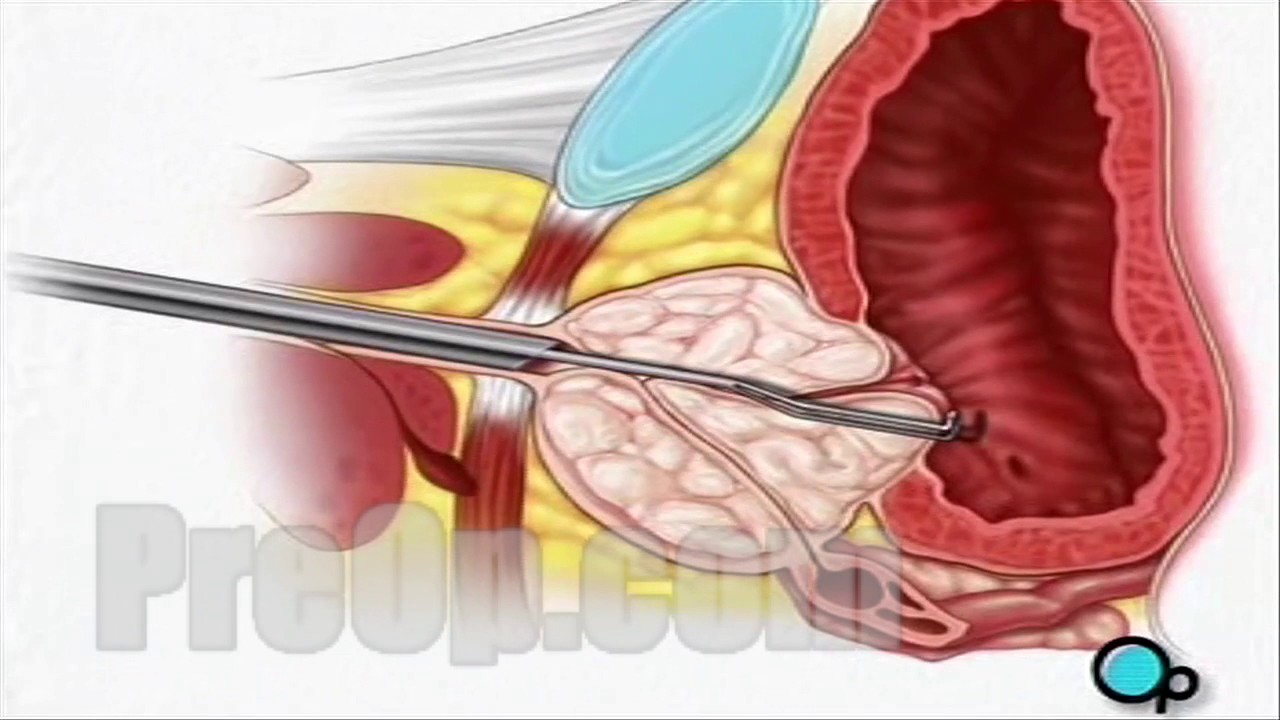 Transurethral Resection of the Prostate (TURP)