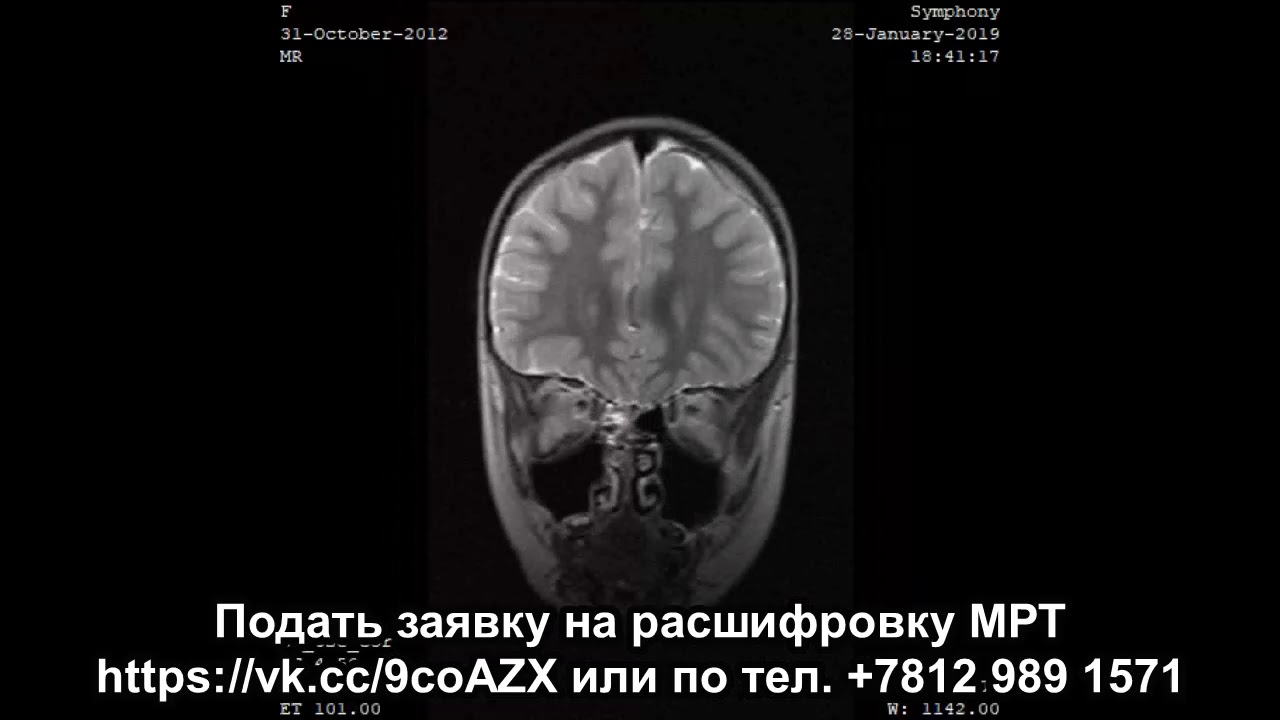 Второе мнение МРТ расшифровка головного мозга у ребенка 6 лет без ...