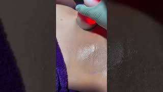 Cryo TShock Body Sculpting