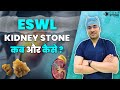 ESWL Kidney Stone कब और कैसे | Lithotripsy से किडनी स्टोन का इलाज | Non-Invasive Procedure #eswl