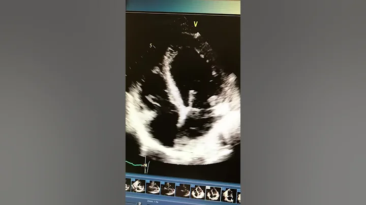 CHF echo