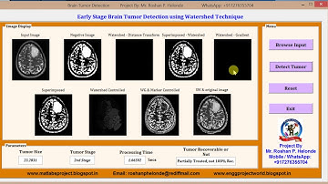 Early Brain tumor Detection using Watershed matlab project source code