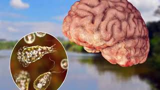 Rare brain-eating amoeba cases found in florida