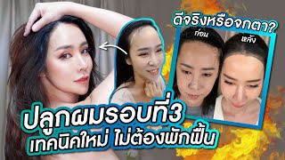 ปลูกผมรอบที่3 ไม่ต้องพักฟื้น ดีจริงหรือจกตา? เทคนิคใหม่ล่าสุด FUE&DHI