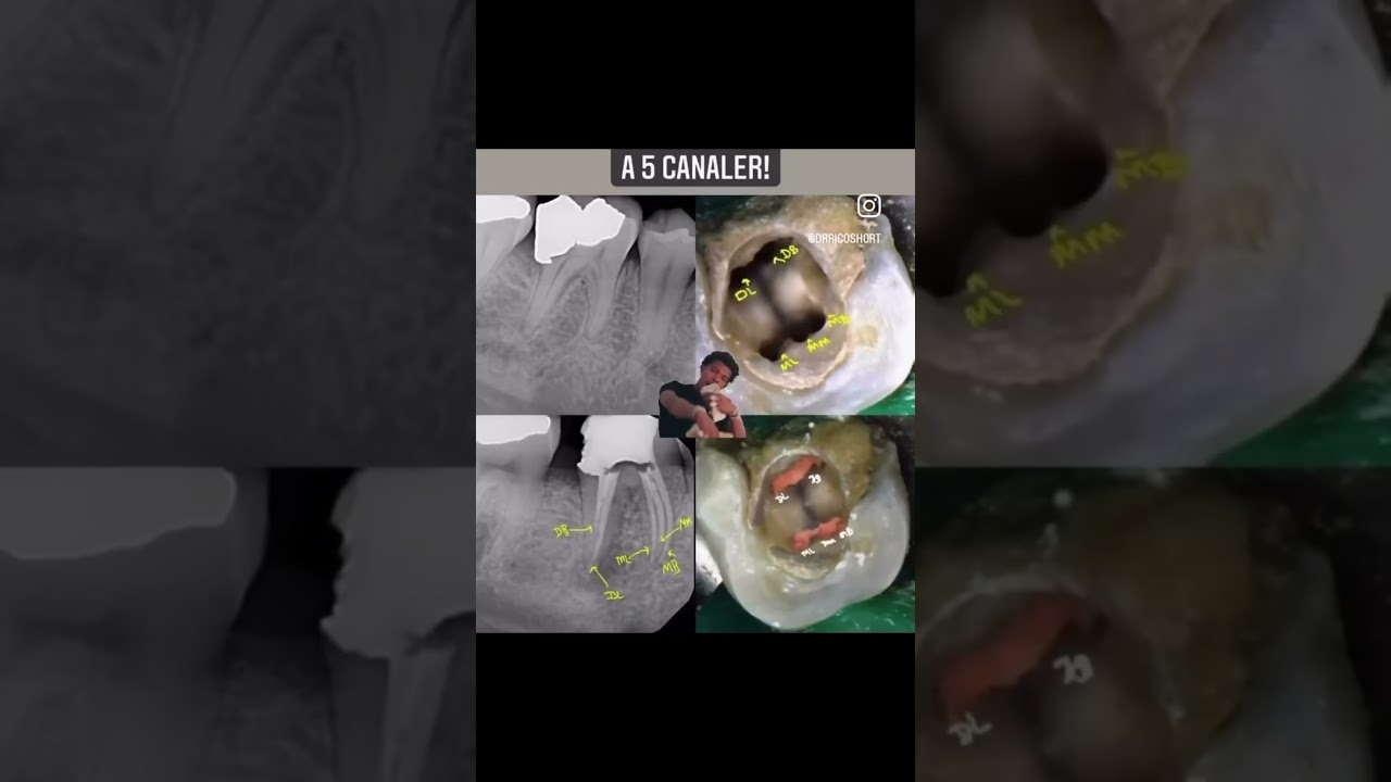 Routine Case?? Pump Your BrakesHow Many Canals Can You Detect? #DrRicoShort #endodontickeysandcases