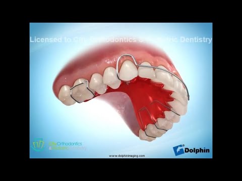 Upper Removable Retainer with Metal Bow | City Orthodontics & Pediatric Dentistry Edmonton