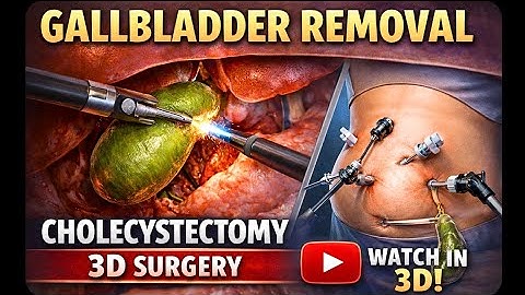 Gallbladder removal surgical 3D video | Cholecystectomy 