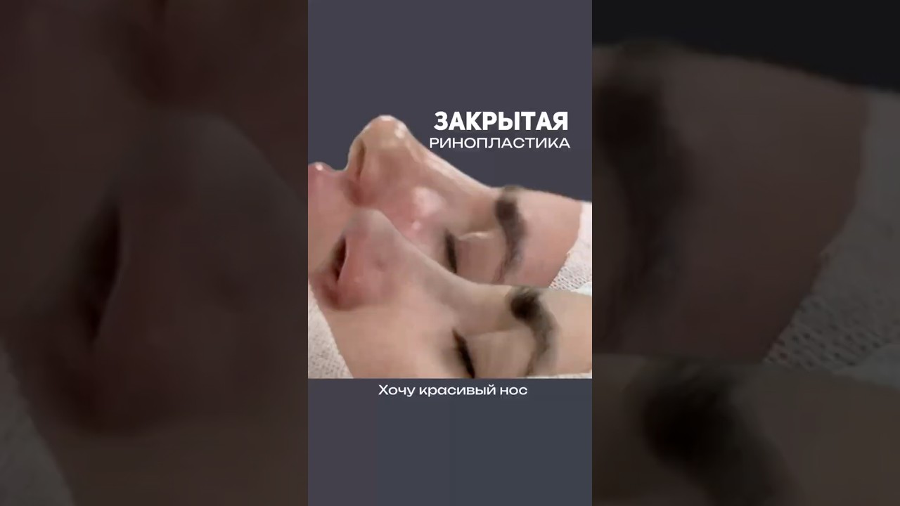 Сделали меньше нос. Пациентка обратилась с просьбой сделать красивую форму носа.