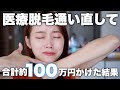 【全部話します】VIO含む全身医療脱毛通い直した結果。毛は無くなった?硬毛化のその後について。痛みやクリニック選びの基準など