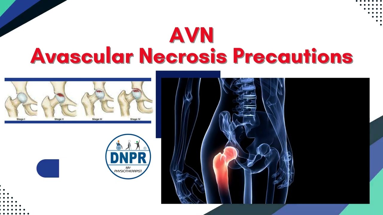 Avascular necrosis (AVN) Precautions I HOW TO PREVENT AVN I Call us for AVN Treatment 9891878611