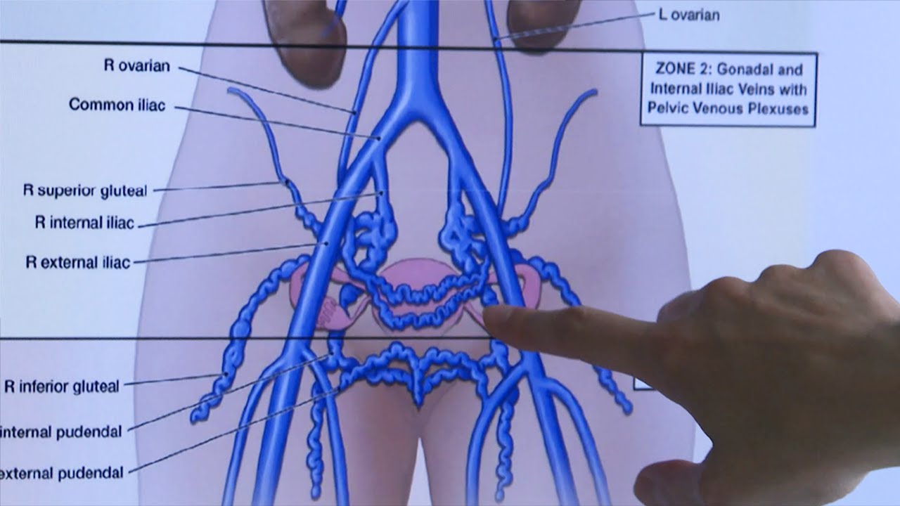 Douleur invisible : nouvel espoir pour les femmes souffrant de varices pelviennes