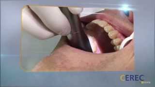 CEREC One Visit For Crowns, Veneers, & Fillings In Vancouver, WA