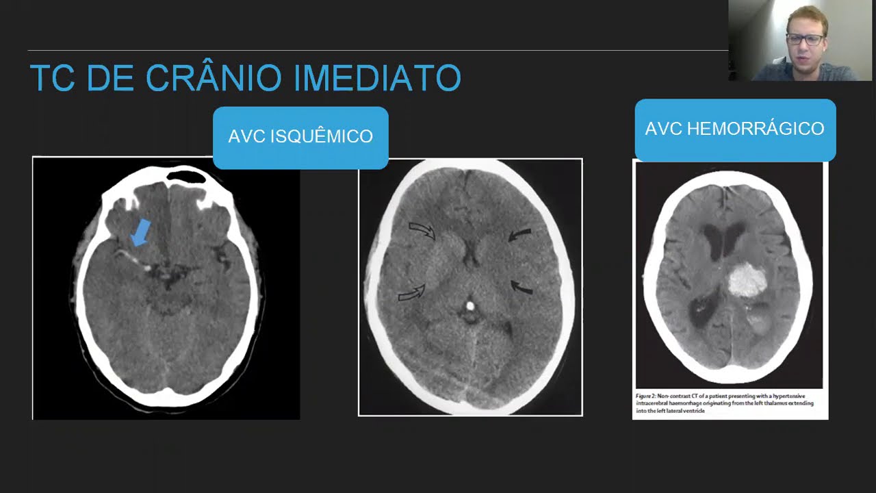 Emergências hipertensivas - Aula 2 - YouTube