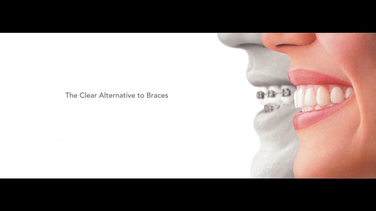 Invisalign Experience (Braces) : Explanation, Before and After | Seoul Guide Medical