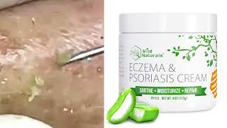 top 10 psoriasis cream