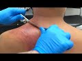 CHIROPRACTIC TREATMENT FOR SHOULDER PAIN | CHIROPRACTIC ADJUSTMENTS CRACKS | YSTRAP ADJUSTMENT