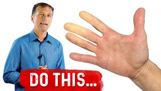 Raynauds Syndrome – What Can you do for Raynaud's Syndrome – Dr.Berg