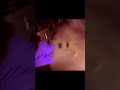 ダブルニワトリトラップ