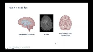 ONAOSI-Yale Final Presentations, Lodovico Balzoni, "Advanced Imaging of Brain Tumors" screenshot 4