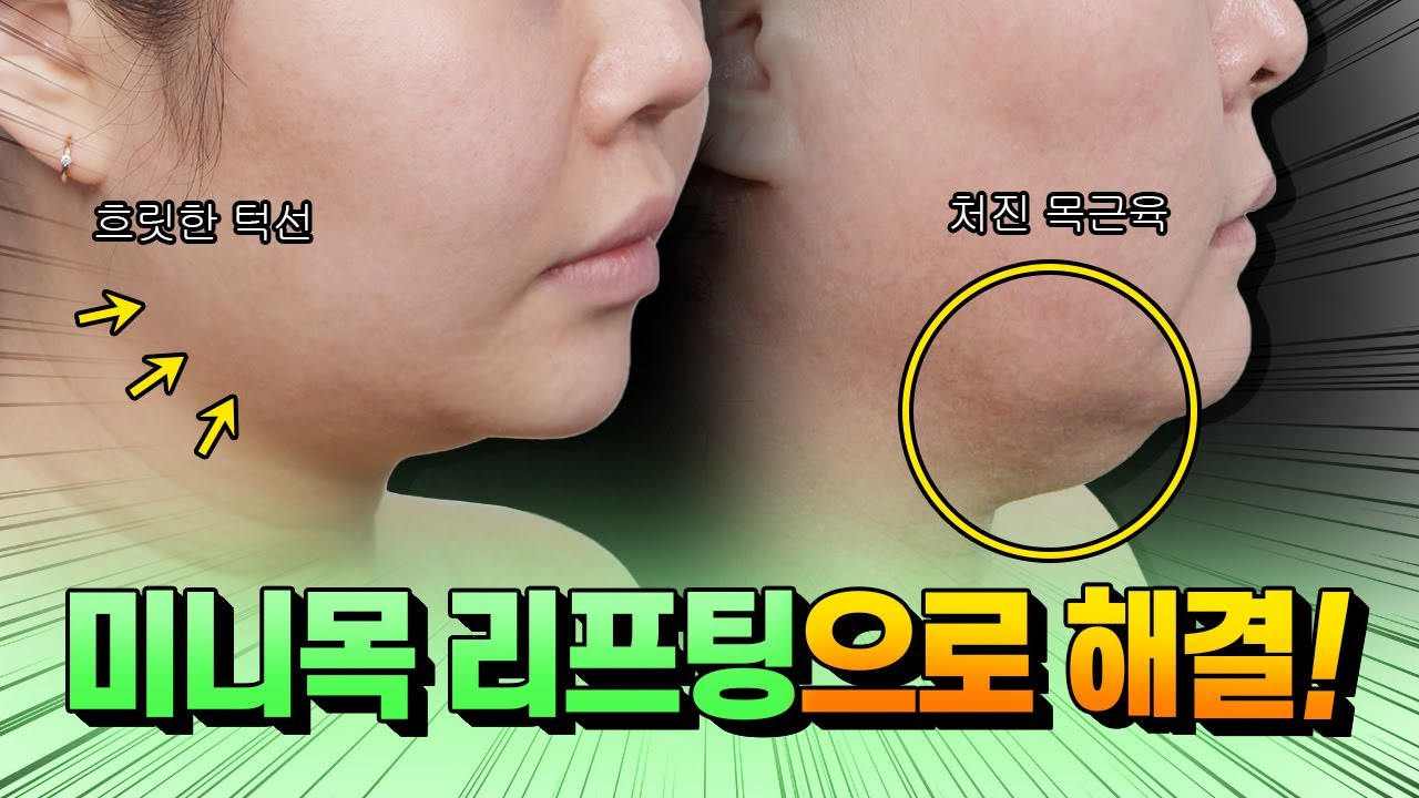 처진 턱살과 턱선 리프팅 해주는 수술이 있다구요?|미니목거상|턱살리프팅|마인성형외과|マイン美容外科 - YouTube