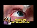 Dry Eyes : Nagluluha, Parang May Buhangin? - ni Doc Willie Ong #731