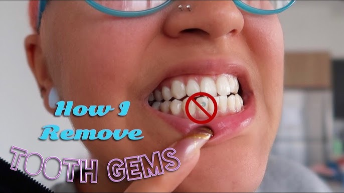 What glue to use for tooth gems? - GlueInfoGuide